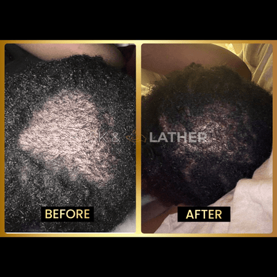 Scalp Stimulator - 3 Month Supply