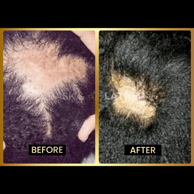 Scalp Stimulator - 3 Month Supply