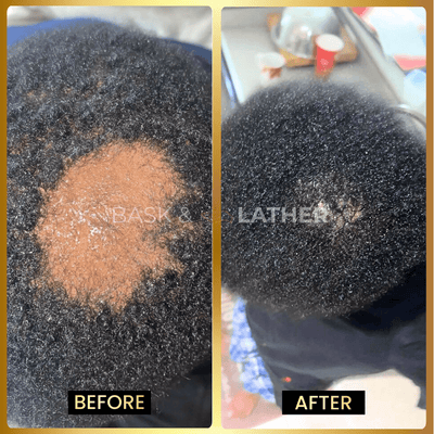 Scalp Stimulator - 3 Month Supply