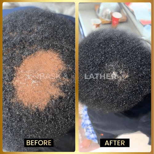 Scalp Stimulator - 3 Month Supply